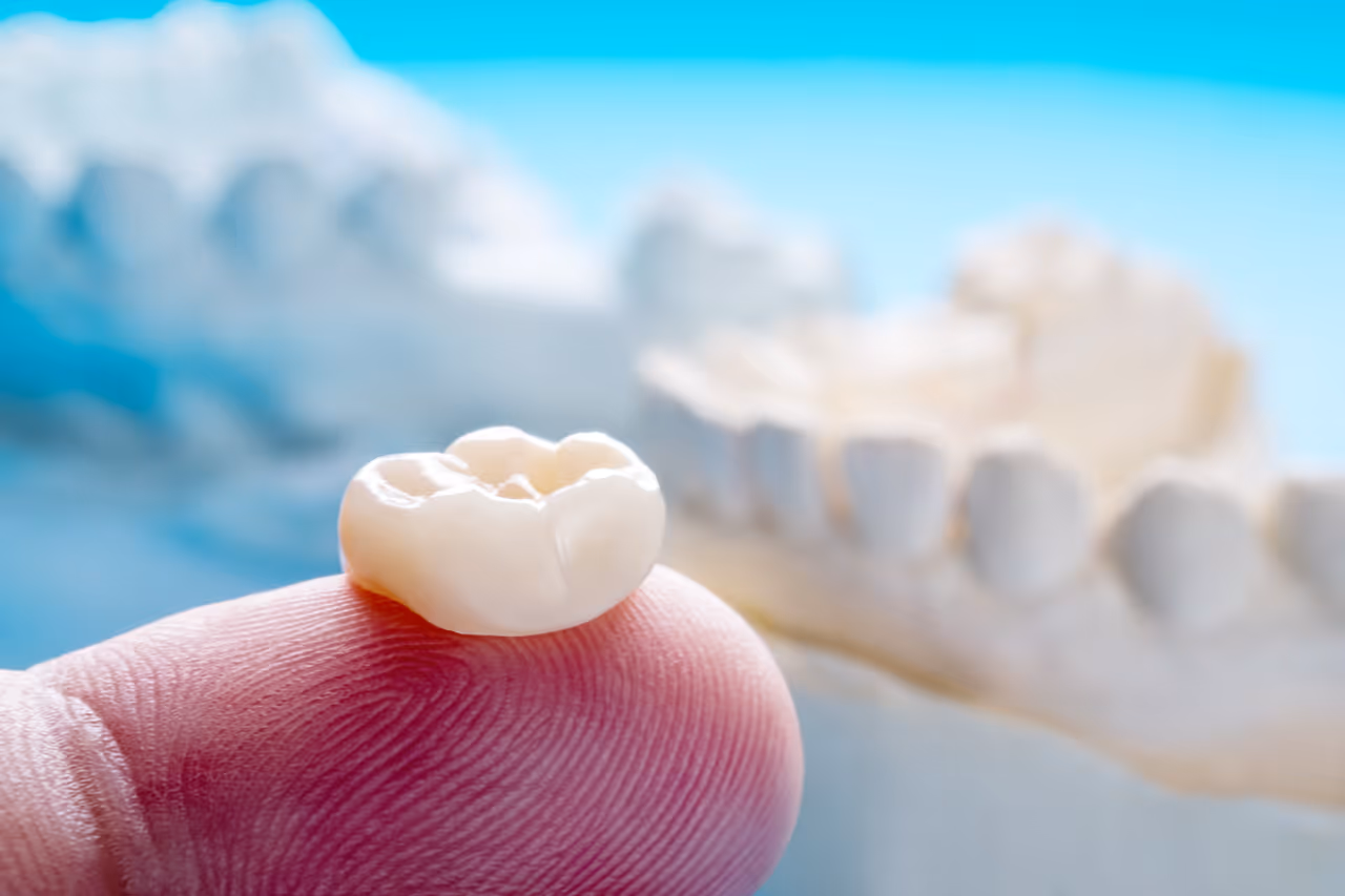 How Dental Crowns Protect Teeth After Large Cavities